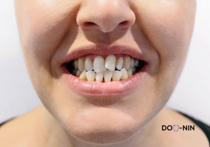 Jak leczyć stłoczenie zębów?
